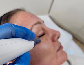 medical-grade micro-needling