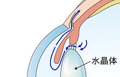 動画でわかる緑内障手術 緑内障手術 | ほしあい眼科【公式】埼玉県さいたま市の眼科・日帰り手術