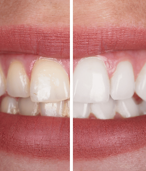 teeth-whitening