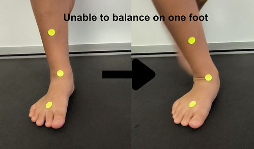Unable to balance on one foot