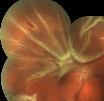 열공성 망막박리