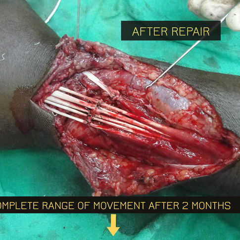 extensor tendon injury-After repair