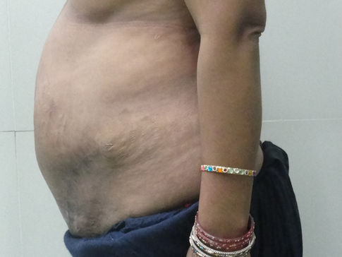 Tummytuck-ABDOMINOPLASTY - After surgery