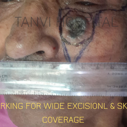 Basal cell carcinoma-BCC-Cheek-