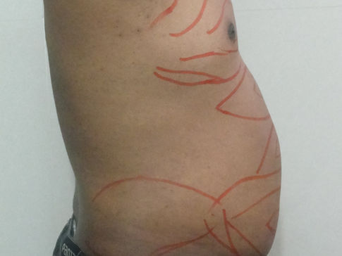 LIPOSUCTION -Befor surgery