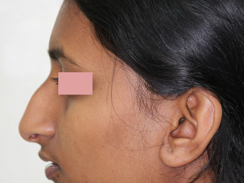 Rhinoplasty-Nose job-before surgery