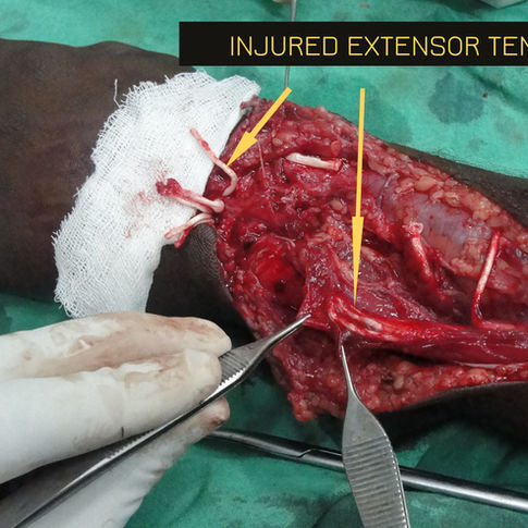 extensor tendon injury-Before repair