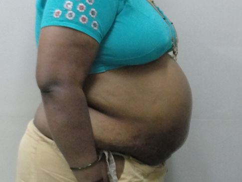 Tummytuck-ABDOMINOPLASTY - After surgery