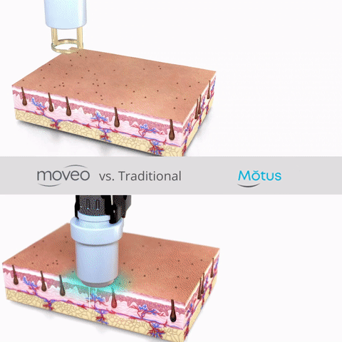 Process of motus hair removal at The SoNu Spa