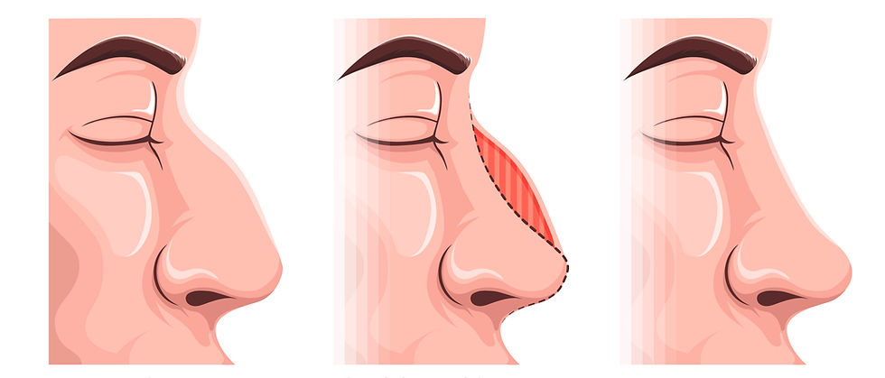 Rinoplastia Masculina e os Estigmas que a Envolvem