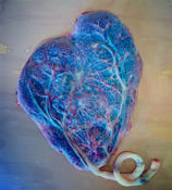 Heart shaped placenta