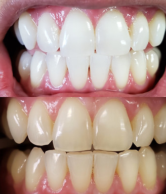 Professional Teeth Whitening