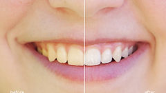 vecteezy_teeth-whitening-before-and-after_43343299.jpg