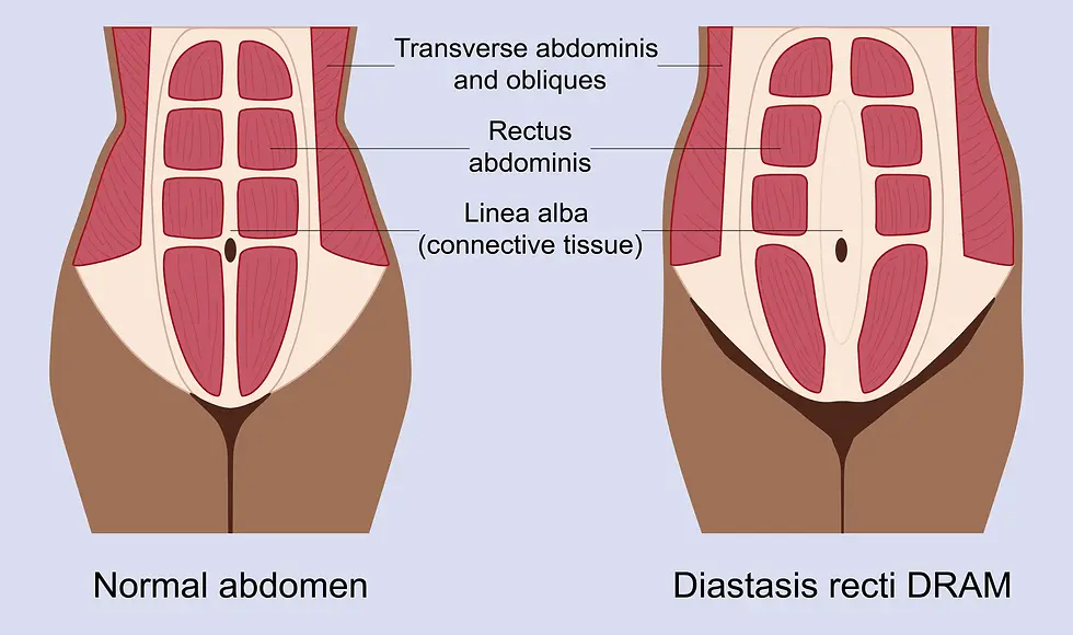 Illustration shows normal abdominal muscles alongside abdominal muscles after diastasis recti (DRAM), also known as abdominal separation.
