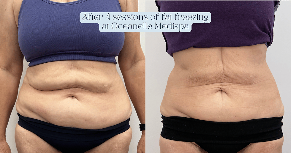 Fat Freezing Results in Wollongong