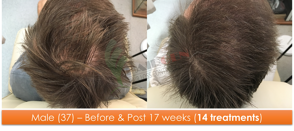 Male (37) - 14 sessions over 17 weeks