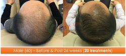 Male (60) - 20 sessions over 26 weeks