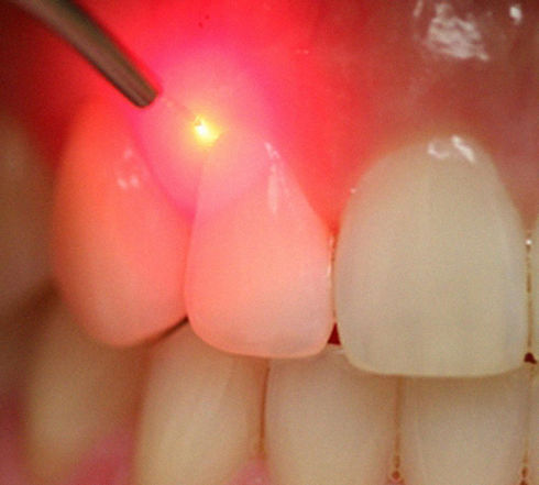 laser-odontologico-doctoraminerva.jpg