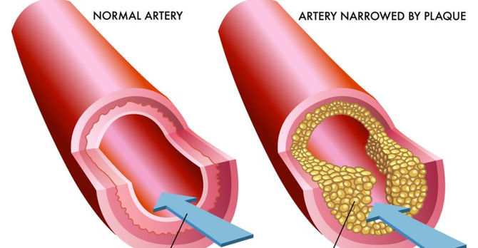 Cholesterol and the effects of atherosclerosis