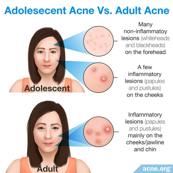 04-adolescent-acne-vs-adult-acne.jpg