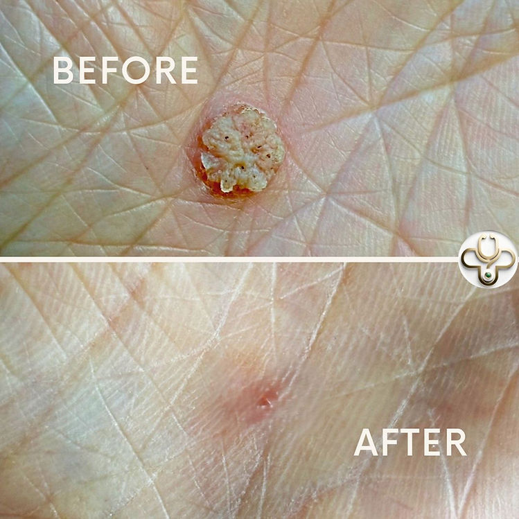 Before after Freezpen.jpg