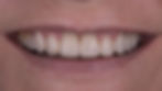Photo d'un sourire après un soin de réhabilitation fonctionnelle et esthétique
