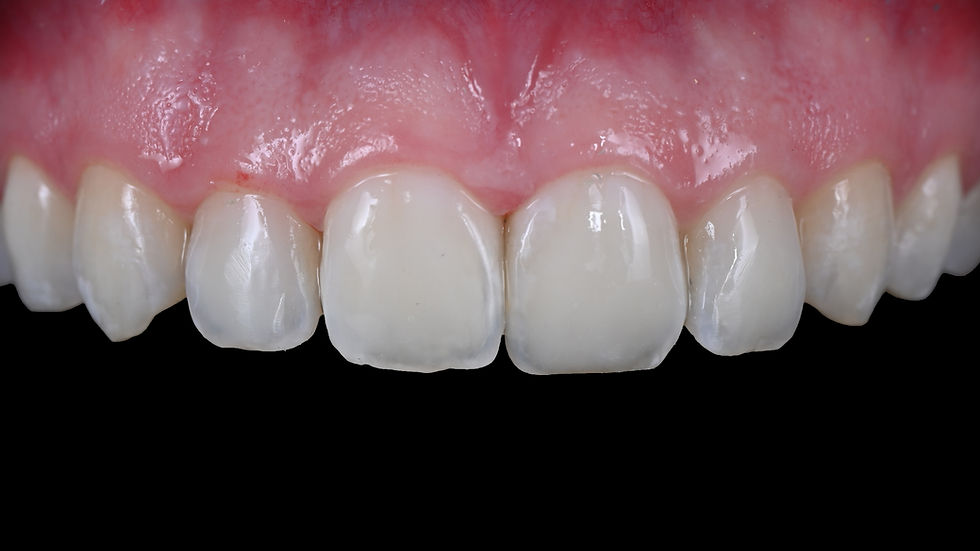 Photo de dents après un traitement contre les tâches blanches