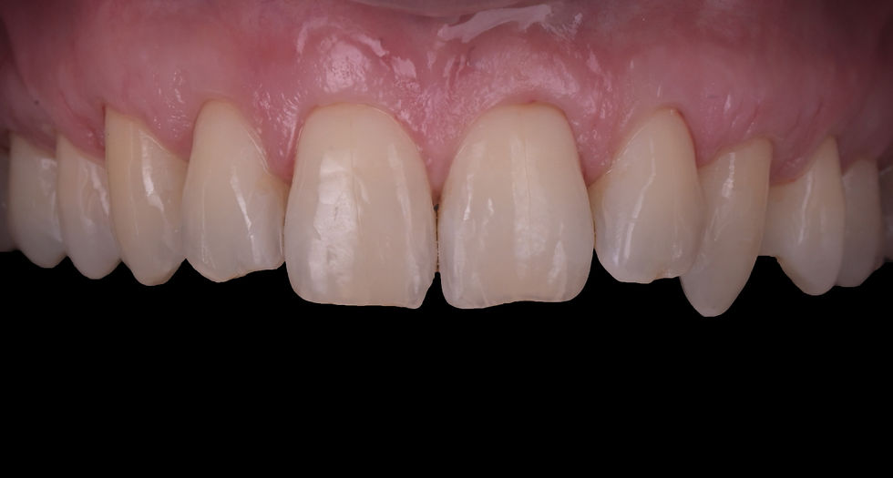 Photo d'une gencive après une chirurg muco-gingivale