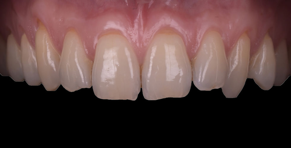 Photo d'une gencive avant une chirurg muco-gingivale