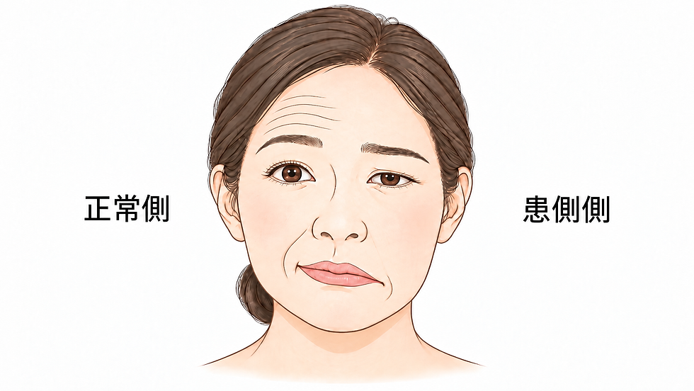 顔面神経麻痺で鍼灸院を受診すると、どのような治療をするのか?