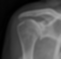 shoulder arthritis.png