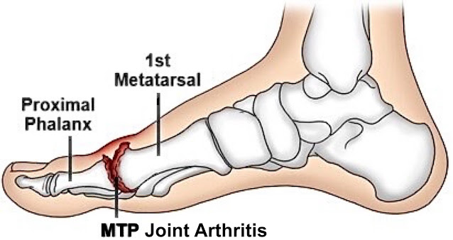 First Metatarsophalangeal Joint Arthritis: Comprehensive Review of Conservative and Surgical Treatment Options