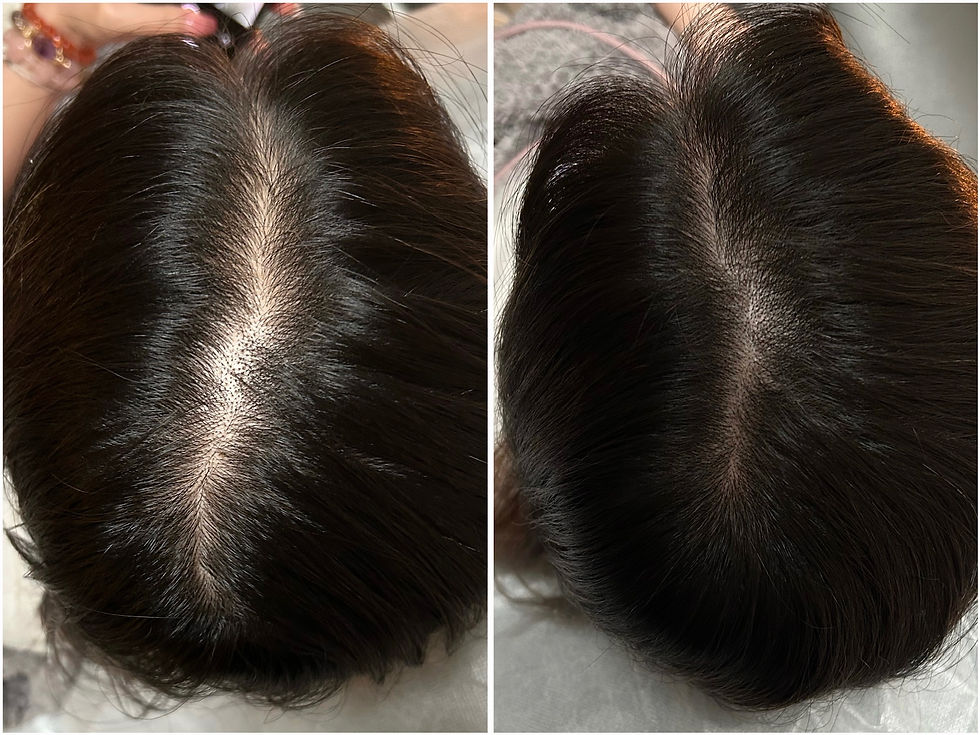 定點生髮(分界線)