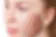 Venus Viva treatment for acne scars – smooths skin and improves complexion