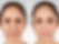 Venus Viva skin tightening treatment for firming loose skin and improving elasticity