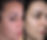 Venus Viva treatment reducing pigmentation and dyschromia for even skin tone