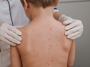 Confirma secretario de Salud 31 contagios de sarampión en BC, la mayoría en Mexicali