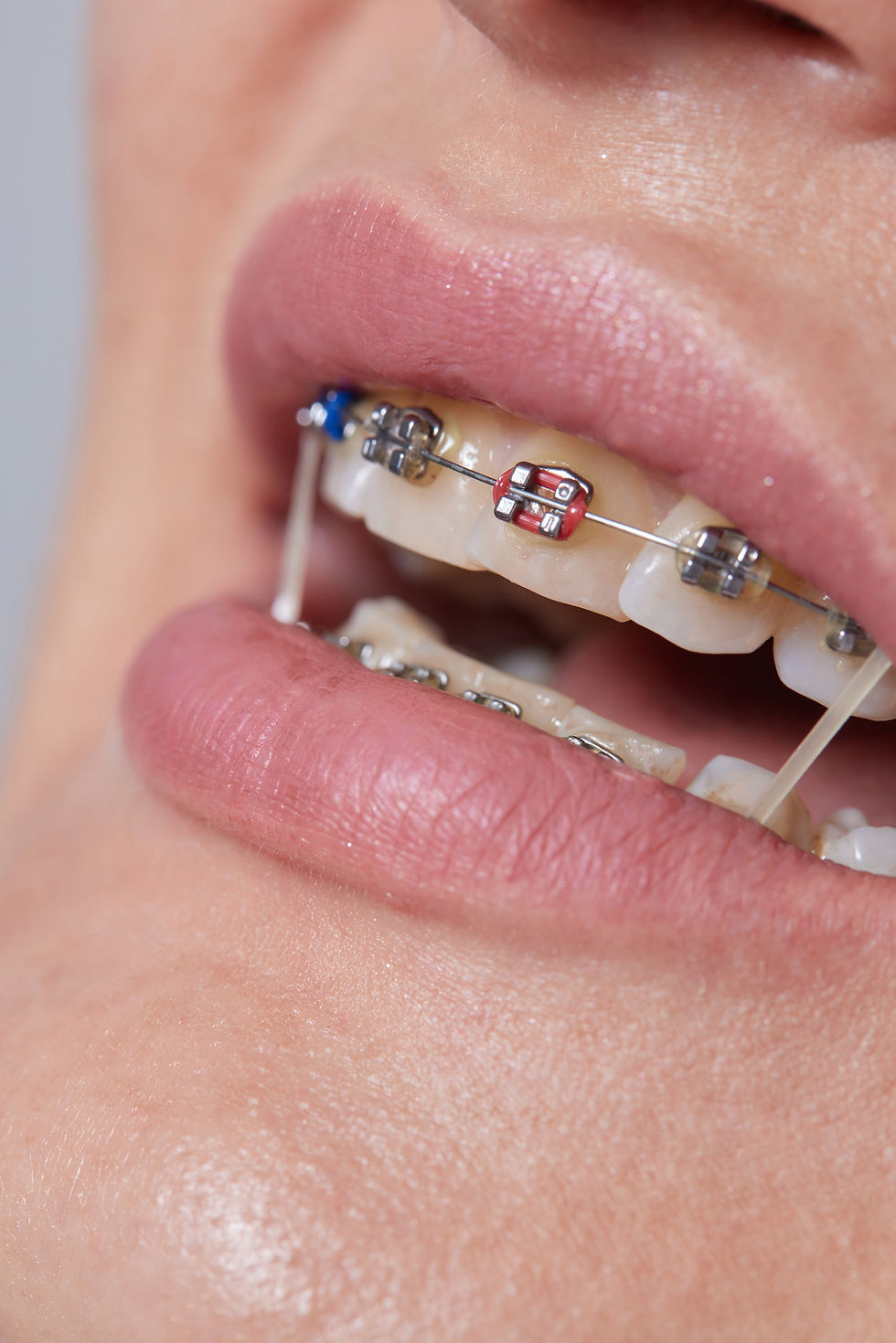 closeup-braces-teeth-with-elastics-orthodontic-treatment-front-view-dental-brackes.jpg