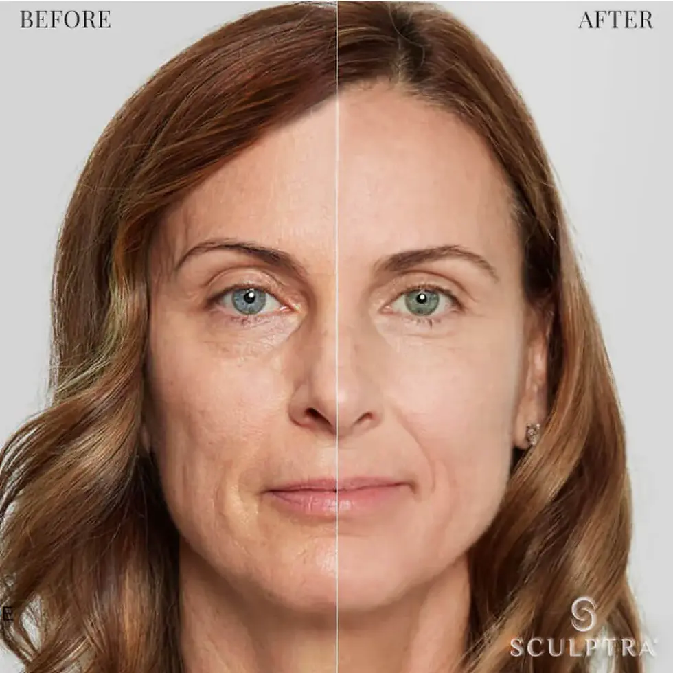 Sculptra en Puerto Vallarta