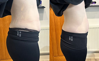 contouring training loughborough, cavitation training loughborough, rf tightening training loughborough