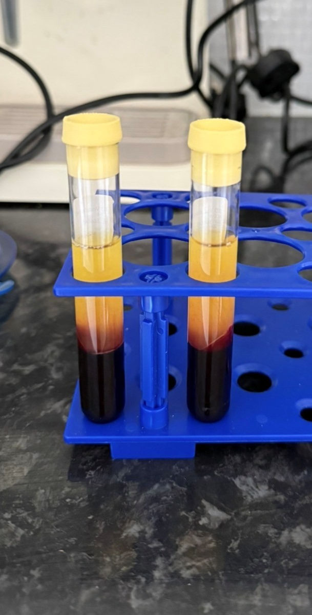 blood samples plasma for PRP treatment
