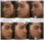 3 session of Microneedling for Acne