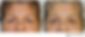 severe wrinkle botox