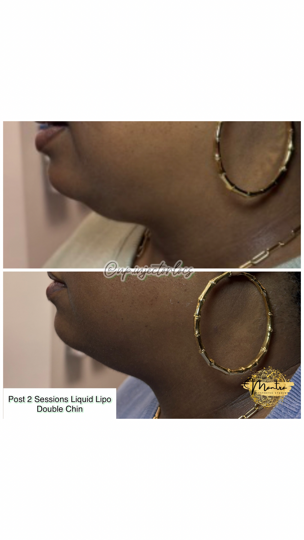 Double Chin Liquid Lipo