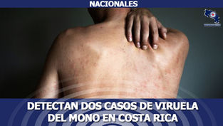 Detectan dos casos de viruela del mono en Costa Rica, salud pide evitar contagio