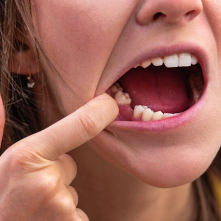 Drug to Re-Grow Teeth