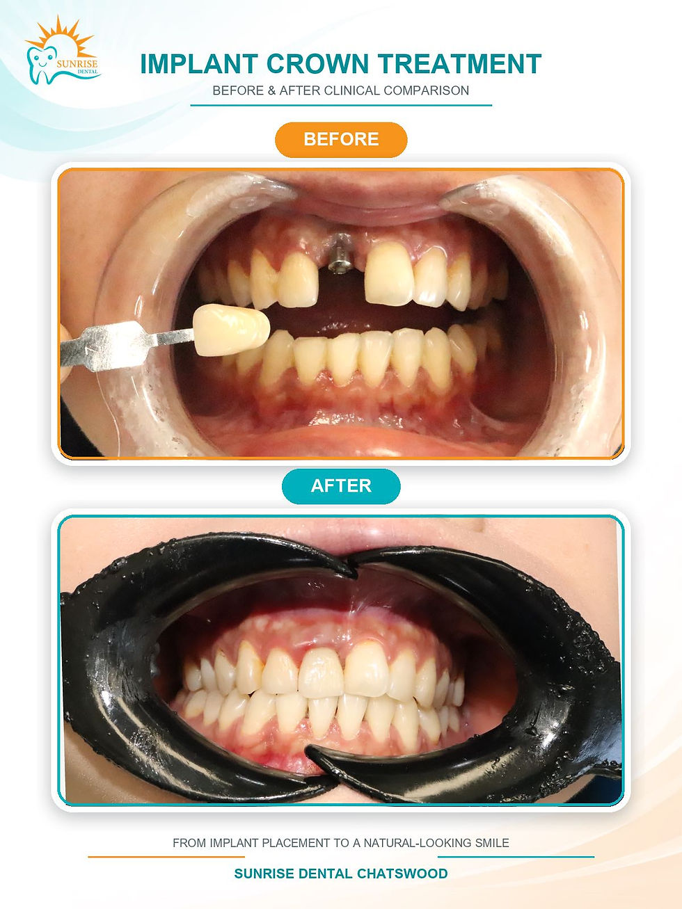 Xiaojie_Wang_Implant_Crown_Before_After_3x4.jpg