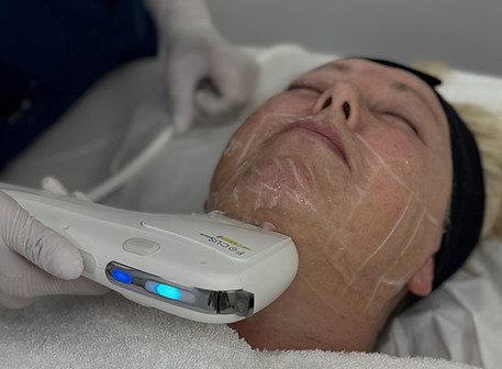 Client receiving HIFU treatment to the lower face and jawline at Crane Medical Clinic in Little Sutton, Ellesmere Port.