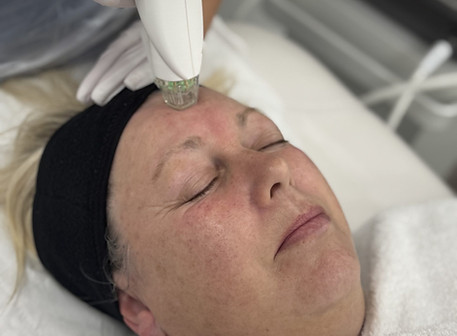 Client receiving RF microneedling treatment to the forehead at Crane Medical Clinic in Little Sutton, Ellesmere Port.