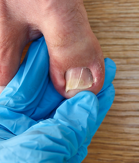 Ingrown Nail